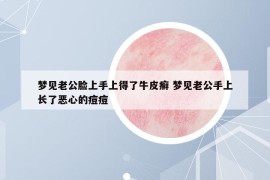 夢見老公臉上手上得了牛皮癬 夢見老公手上長了惡心的痘痘
