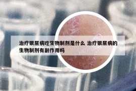 治療銀屑病吃生物制劑是什么 治療銀屑病的生物制劑有副作用嗎