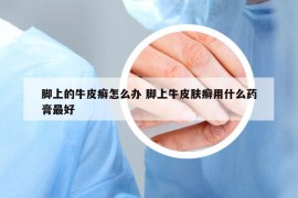 腳上的牛皮癬怎么辦 腳上牛皮膚癬用什么藥膏最好
