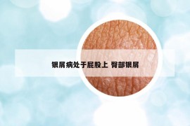 銀屑病處于屁股上 臀部銀屑