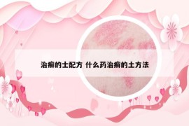治癬的士配方 什么藥治癬的土方法