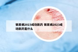 銀屑病2023成功新藥 銀屑病2023成功新藥是什么