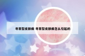 尋常型皮膚癬 尋常型皮膚癬怎么引起的