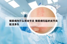 銀屑病為什么得關節(jié)炎 銀屑病引起的關節(jié)炎能活多久