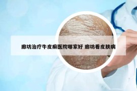 廊坊治療牛皮癬醫(yī)院哪家好 廊坊看皮膚病