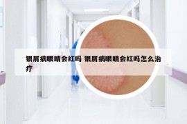 銀屑病眼睛會紅嗎 銀屑病眼睛會紅嗎怎么治療