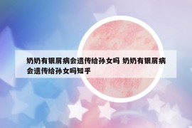 奶奶有銀屑病會遺傳給孫女嗎 奶奶有銀屑病會遺傳給孫女嗎知乎