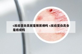 c反應(yīng)蛋白高就是銀屑病嗎 c反應(yīng)蛋白高會(huì)是癌癥嗎