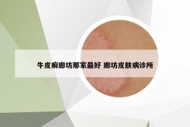 牛皮癬廊坊那家最好 廊坊皮膚病診所