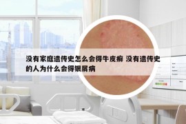 沒(méi)有家庭遺傳史怎么會(huì)得牛皮癬 沒(méi)有遺傳史的人為什么會(huì)得銀屑病