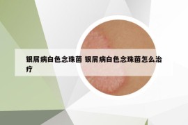 銀屑病白色念珠菌 銀屑病白色念珠菌怎么治療