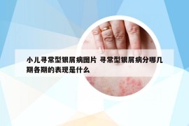 小兒尋常型銀屑病圖片 尋常型銀屑病分哪幾期各期的表現是什么
