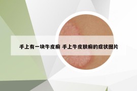 手上有一塊牛皮癬 手上牛皮膚癬的癥狀圖片