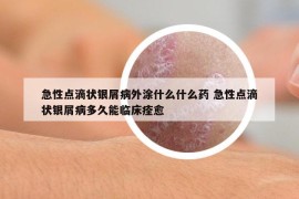急性點(diǎn)滴狀銀屑病外涂什么什么藥 急性點(diǎn)滴狀銀屑病多久能臨床痊愈