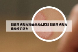 副銀屑病和玫瑰糠疹怎么區(qū)別 副銀屑病和玫瑰糠疹的區(qū)別