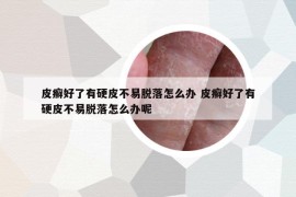皮癬好了有硬皮不易脫落怎么辦 皮癬好了有硬皮不易脫落怎么辦呢