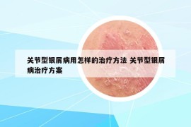 關(guān)節(jié)型銀屑病用怎樣的治療方法 關(guān)節(jié)型銀屑病治療方案