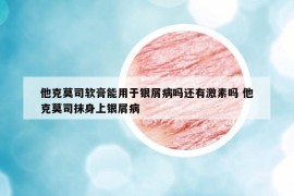 他克莫司軟膏能用于銀屑病嗎還有激素嗎 他克莫司抹身上銀屑病