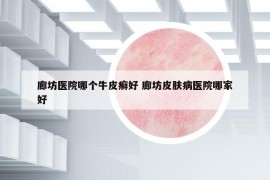廊坊醫(yī)院哪個牛皮癬好 廊坊皮膚病醫(yī)院哪家好