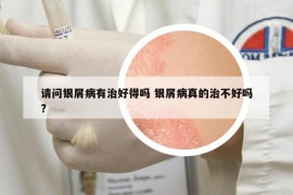 請(qǐng)問(wèn)銀屑病有治好得嗎 銀屑病真的治不好嗎?