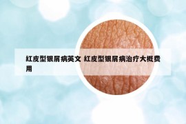 紅皮型銀屑病英文 紅皮型銀屑病治療大概費(fèi)用