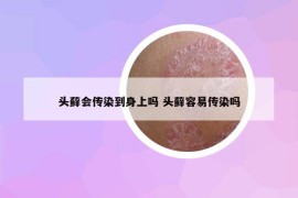 頭蘚會傳染到身上嗎 頭蘚容易傳染嗎