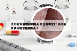 衡陽哪家治銀屑病最好的醫(yī)院哪家好 衡陽看皮膚科哪家醫(yī)院最好?