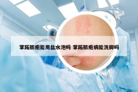 掌跖膿皰能用鹽水泡嗎 掌跖膿皰病能洗腳嗎