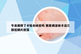 牛皮癬擦了卡鉑會掉皮嗎 銀屑病涂抹卡泊三醇后鱗片脫落