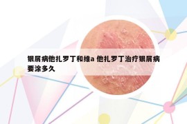 銀屑病他扎羅丁和維a 他扎羅丁治療銀屑病要涂多久