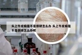 頭上牛皮癬是不是很硬怎么辦 頭上牛皮癬是不是很硬怎么辦呢