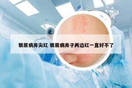 銀屑病鼻尖紅 銀屑病鼻子兩邊紅一直好不了