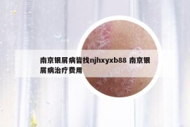 南京銀屑病皆找njhxyxb88 南京銀屑病治療費(fèi)用