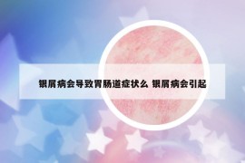 銀屑病會導致胃腸道癥狀么 銀屑病會引起