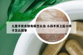 兒童手背皮膚有癬怎么治 小孩手背上起小疹子怎么回事