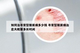 如何治尋常型銀屑病多少錢 尋常型銀屑病治愈大概要多長時間