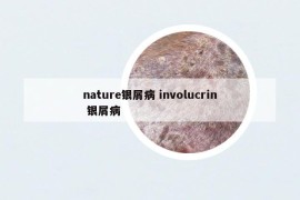 nature銀屑病 involucrin 銀屑病