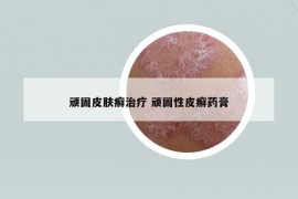 頑固皮膚癬治療 頑固性皮癬藥膏