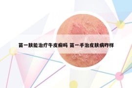 苗一膚能治療牛皮癬嗎 苗一手治皮膚病咋樣