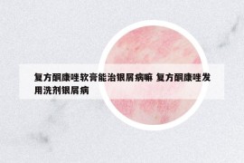 復(fù)方酮康唑軟膏能治銀屑病嘛 復(fù)方酮康唑發(fā)用洗劑銀屑病