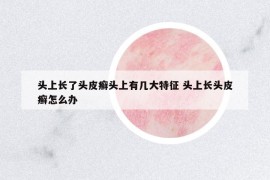 頭上長(zhǎng)了頭皮癬頭上有幾大特征 頭上長(zhǎng)頭皮癬怎么辦