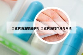 工業(yè)黃油治銀屑病嗎 工業(yè)黃油的作用與用法