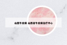 山西牛皮癬 山西省牛皮癬治療中心