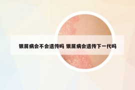 銀屑病會不會遺傳嗎 銀屑病會遺傳下一代嗎