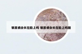 銀屑病會長在臉上嗎 銀屑病會長在臉上嗎圖