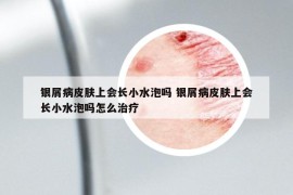 銀屑病皮膚上會長小水泡嗎 銀屑病皮膚上會長小水泡嗎怎么治療
