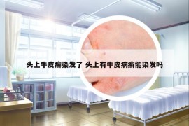 頭上牛皮癬染發(fā)了 頭上有牛皮病癬能染發(fā)嗎