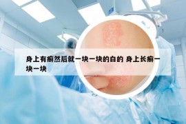 身上有癬然后就一塊一塊的白的 身上長癬一塊一塊