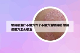 銀屑病治療小偏方六個小偏方治銀屑病 銀屑病偏方怎么根治