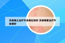 濟南哪兒治療牛皮癬比較好 濟南哪里治療牛皮癬好
